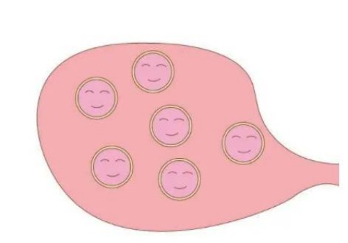 乳腺结节会自己消退吗？什么方法可以消除乳腺结节？